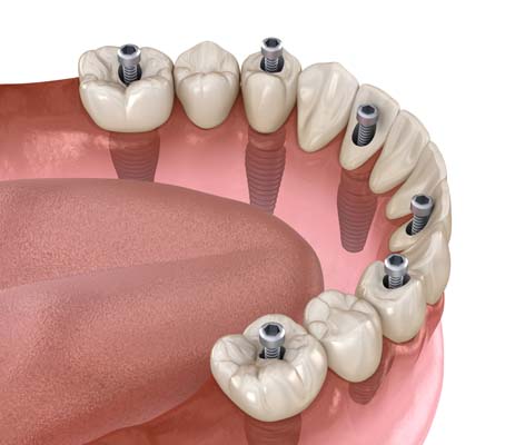 A Brief Comparison Between Implant Supported Dentures And Traditional Dentures